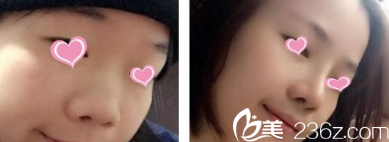 淮北相山時光劉家賀隆鼻綜合整形案例 淮北相山時光劉家賀隆鼻綜合整形案例