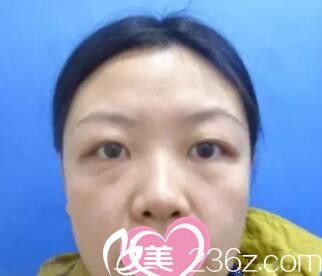 雙眼皮開眼角術(shù)前照 雙眼皮開眼角術(shù)前照