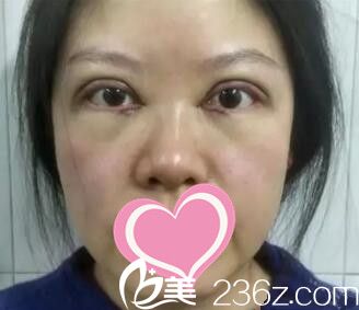 雙眼皮+開眼角術(shù)后天照片 雙眼皮+開眼角術(shù)后天照片