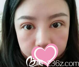 在沈陽名流做雙眼皮開眼角術(shù)后10天效果 在沈陽名流做雙眼皮開眼角術(shù)后10天效果