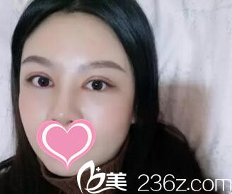 做開眼角雙眼皮術(shù)后21天時(shí)恢復(fù)效果 做開眼角雙眼皮術(shù)后21天時(shí)恢復(fù)效果