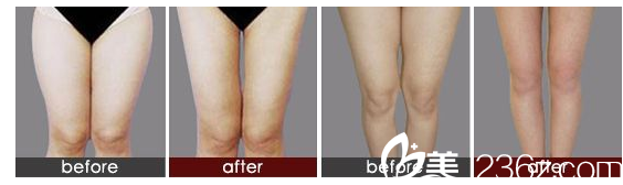 大腿吸脂前后對(duì)比案例