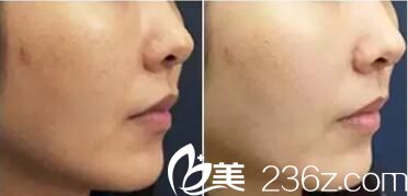 皮秒凈膚激光去黃褐斑