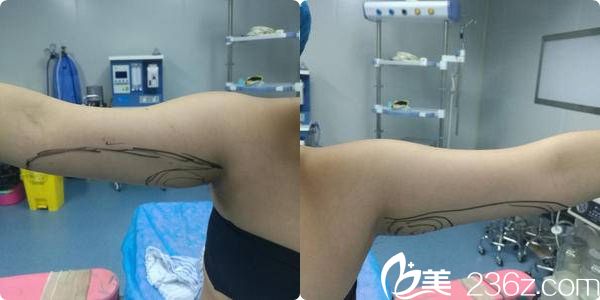 激光溶脂瘦胳膊術(shù)前劃線設(shè)計(jì) 激光溶脂瘦胳膊術(shù)前劃線設(shè)計(jì)