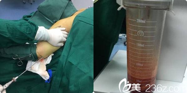 溶脂瘦胳膊手術(shù)中 溶脂瘦胳膊手術(shù)中