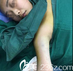 剛做完激光溶脂瘦胳膊 剛做完激光溶脂瘦胳膊