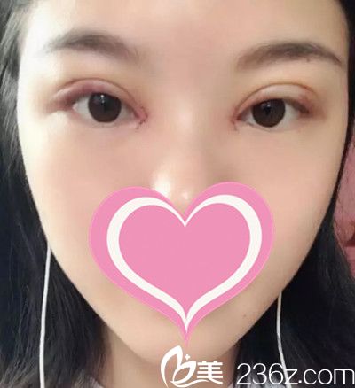 雙眼皮術(shù)后4天 雙眼皮術(shù)后4天