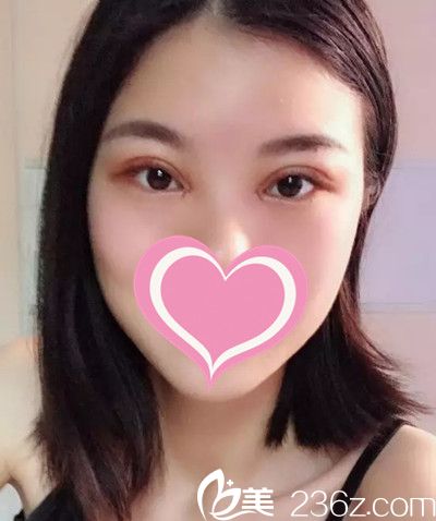 雙眼皮手術(shù)一周了 雙眼皮手術(shù)一周了