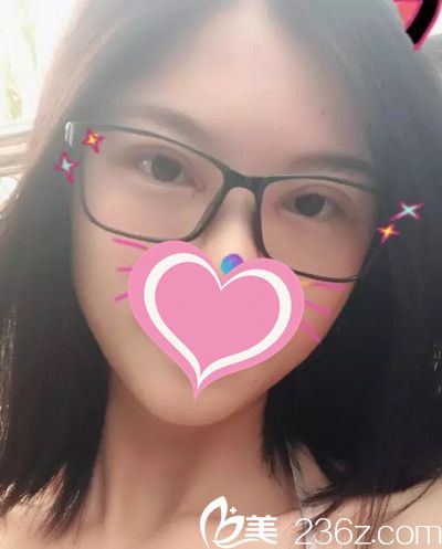 吳中望院長(zhǎng)雙眼皮手術(shù)案例 吳中望院長(zhǎng)雙眼皮手術(shù)案例