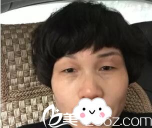 在郴州唯美做雙眼皮術(shù)前照 在郴州唯美做雙眼皮術(shù)前照