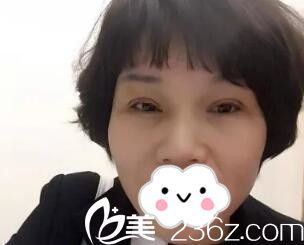 做切開雙眼皮術(shù)后一周效果 做切開雙眼皮術(shù)后一周效果