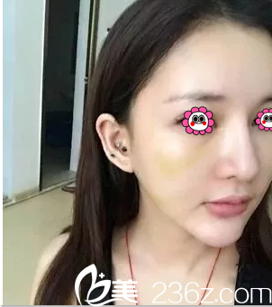 麗都石冰給我做埋線提升第3天效果 麗都石冰給我做埋線提升第3天效果