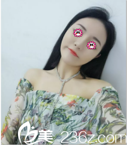 北京米蘭柏羽麗都面部埋線提升案例 北京米蘭柏羽麗都面部埋線提升案例