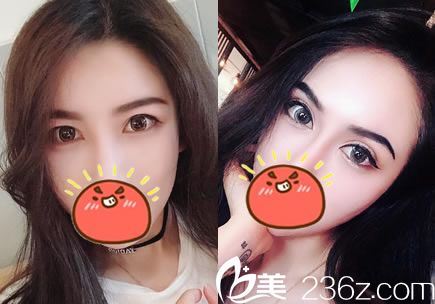 杭州連天美姜鑫利割雙眼皮案例