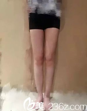 妹子在贛州儷人整形醫(yī)院做了吸脂瘦腿手術后兩個月的分享日記