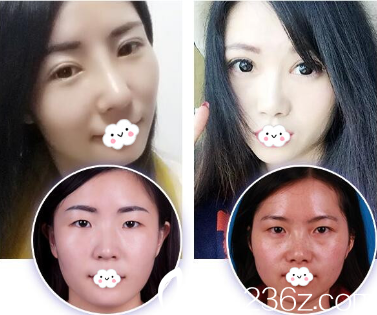 淮北時光雙眼皮真人案例效果對比圖