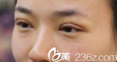 我在韓國清潭做雙眼皮天照片