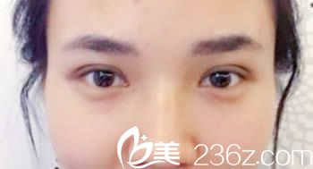 韓國清潭切開雙眼皮術(shù)后10天圖