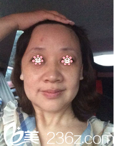 我的術(shù)前照片 我的術(shù)前照片