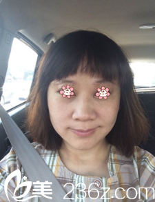 朱曉東面部埋線(xiàn)提升術(shù)后半個(gè)月 朱曉東面部埋線(xiàn)提升術(shù)后半個(gè)月