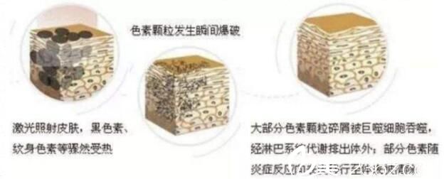 皮秒激光祛斑反黑怎么辦