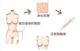 自體脂肪豐胸過程示意圖