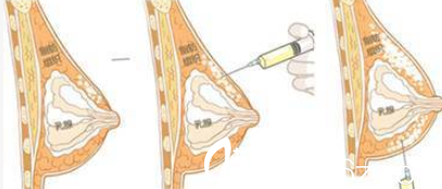 脂肪豐胸注射示意圖