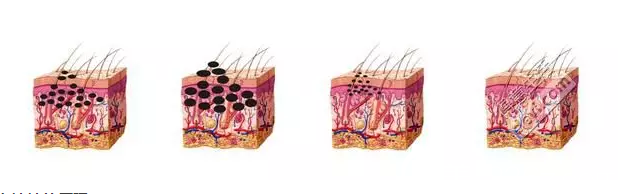 白瓷娃娃清除黑色素過程示意圖