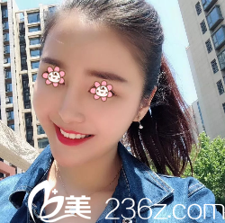 何林面部線雕提升術(shù)后10天