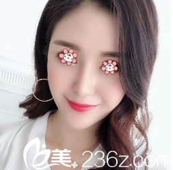 寧夏華美整形美容醫(yī)院何林這個面部線雕提升做得讓我有了個美美的蘋果??！