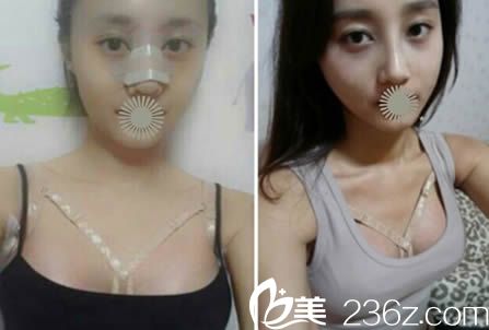 聽網(wǎng)上說韓國博朗溫做鼻綜合隆鼻很出名 我覺得本院的假體隆胸效果更完美