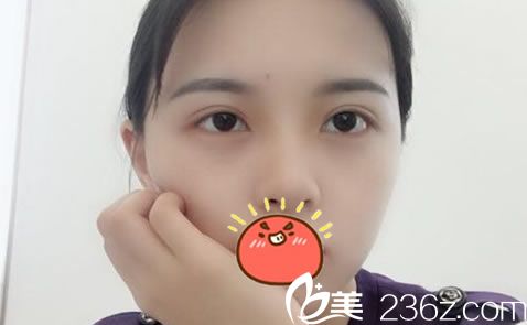 相信看了我在金華瑞麗找劉政院長做雙眼皮和開眼角的恢復(fù)效果,你也會想割雙眼皮的