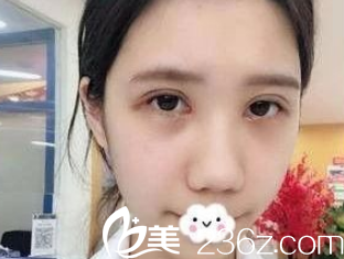 術(shù)后18天眼睛已經(jīng)消腫