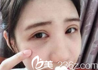 術(shù)后雙眼皮微腫眼袋消除