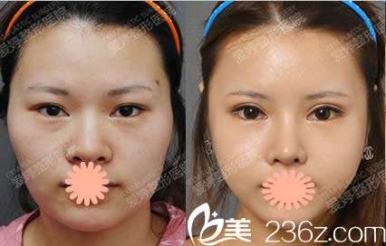 韓國愛婷整形醫(yī)院好嗎?請看我做完雙眼皮失敗修復(fù)/隆鼻/磨顴骨的案例分享