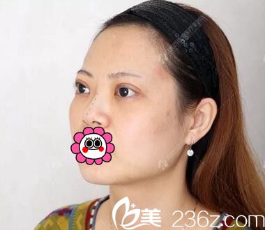 玻尿酸隆鼻術前照 玻尿酸隆鼻術前照