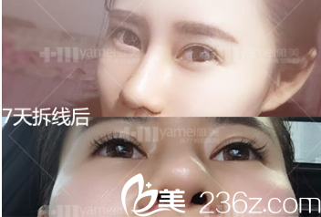 術后一周 術后一周