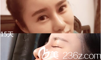 術后半個月 術后半個月