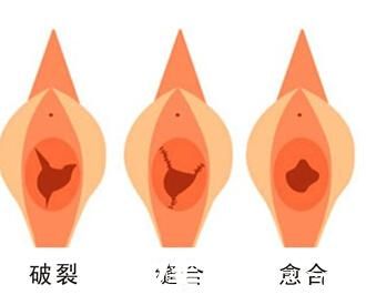 處女膜修復(fù)術(shù)效果圖