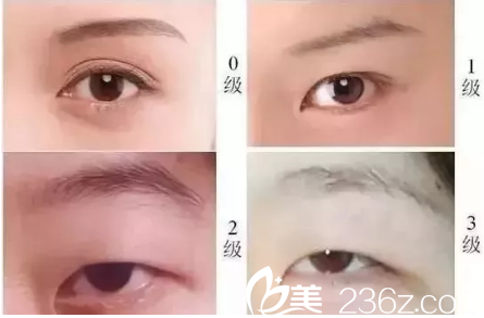 內眥贅皮不同嚴重程度