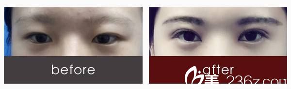 雙眼皮+開眼角案例