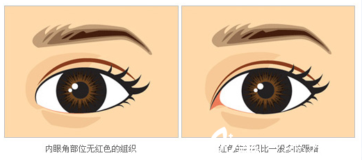 需要開眼角的眼部形態(tài)