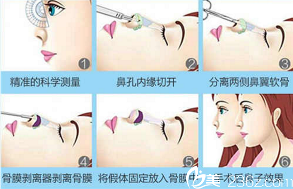 膨體隆鼻手術(shù)原理