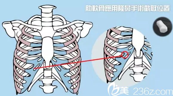 肋軟骨隆鼻取出位置