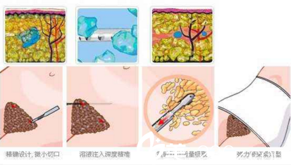 腰腹吸脂過(guò)程圖