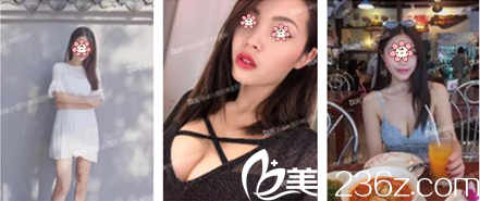 重慶銅雀臺李信奎假體隆胸案例 重慶銅雀臺李信奎假體隆胸案例