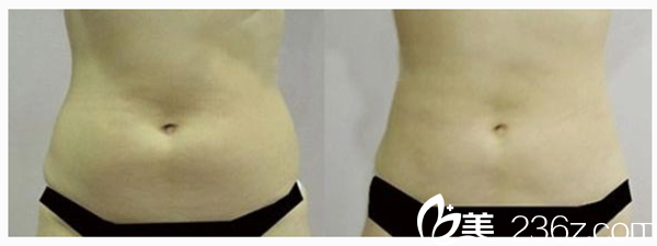 吸脂瘦腹部前后對比
