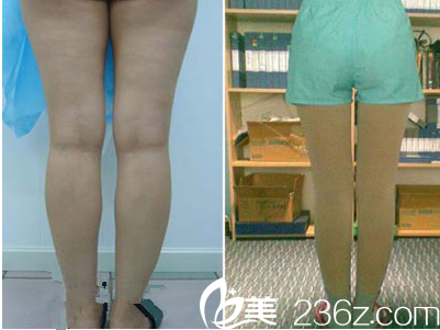 超龍吸脂瘦腿真人案例
