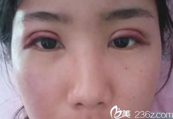 全切雙眼皮天眼睛很腫