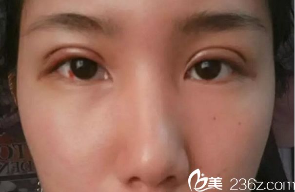 割雙眼皮第五天